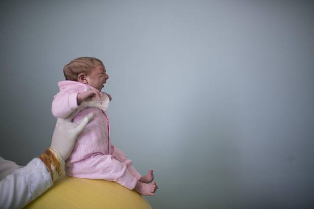 In 2015, the rates of birth defects appeared to be manyfold higher in northeastern Brazil than the rest of the country, and a much greater proportion of the affected babies had more severe clinical presentations such as microcephaly. Sophia, seen as a two-week-old during a physical therapy session in the northeastern city of Campina Grande on Feb. 12, 2016, was born with microcephaly.